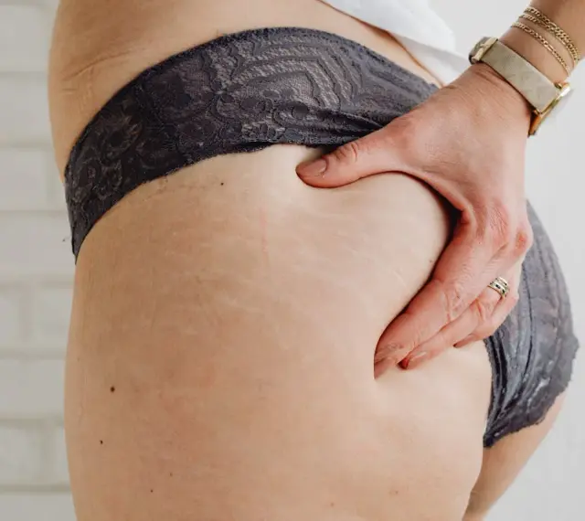 Dłoń uciska udo, na którym widoczne są rozstępy. Cieszy mnie, że schudłam z ud 5 cm, czuję się pewniej.
